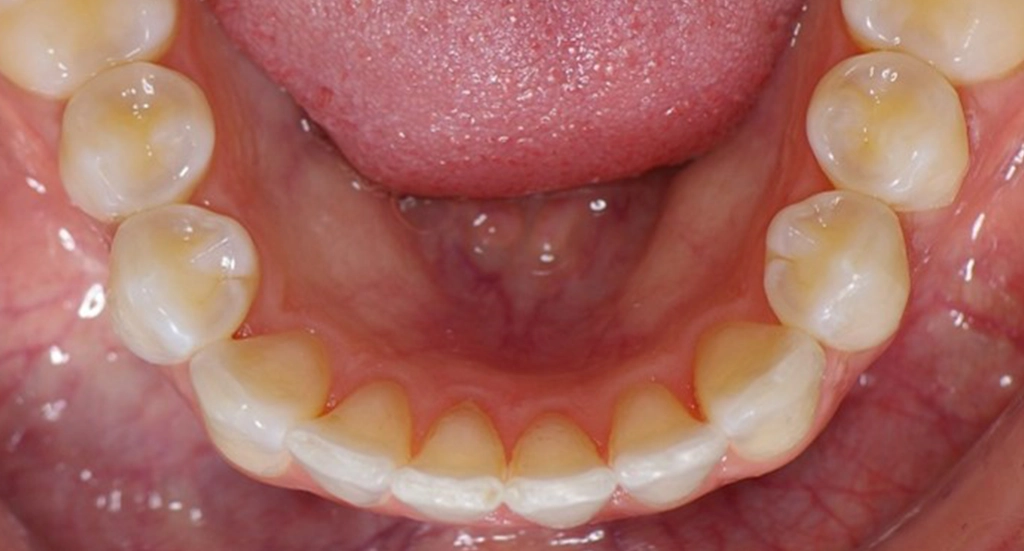 Invisalign5TeethAfter Invisalign5TeethAfter