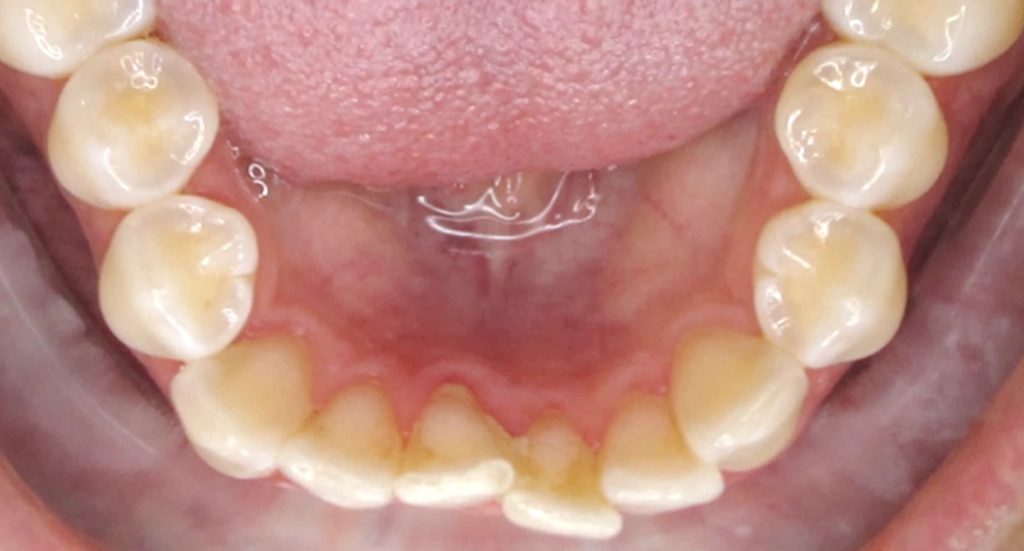 Invisalign5TeethBefore Invisalign5TeethBefore