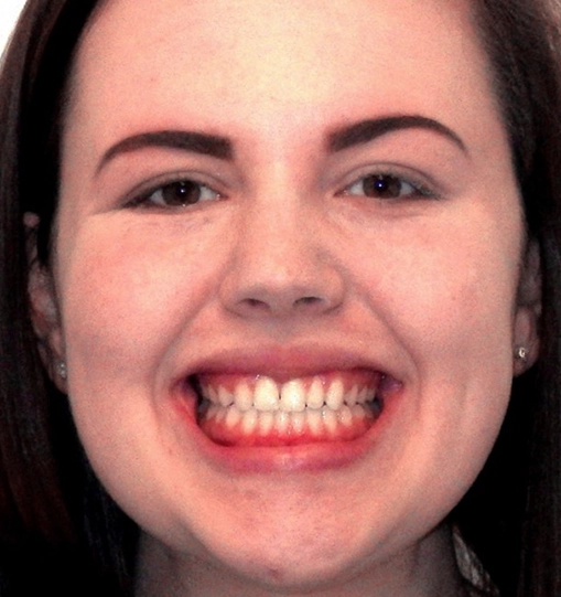 Invisalign6After Invisalign6After