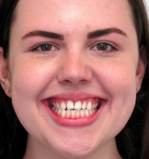 Invisalign6Before Invisalign6Before