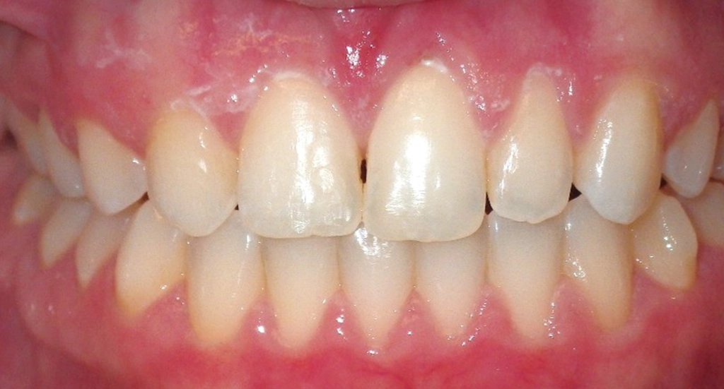 Invisalign6TeethAfter Invisalign6TeethAfter