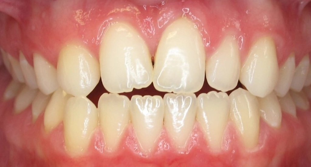 Invisalign6TeethBefore Invisalign6TeethBefore