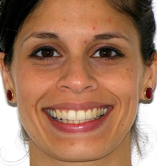 Invisalign7After Invisalign7After
