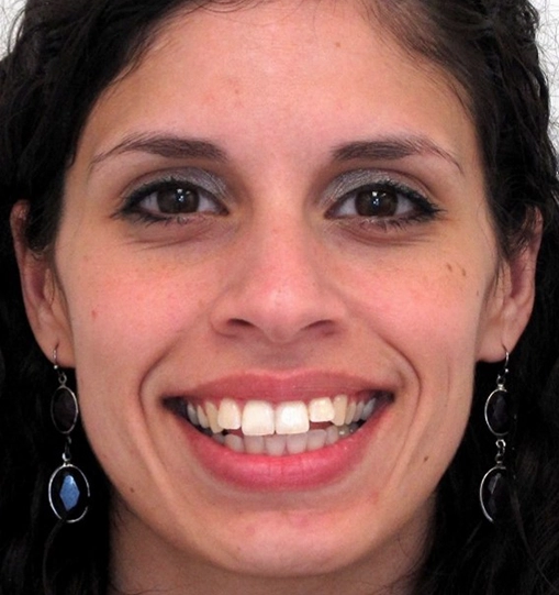 Invisalign7Before Invisalign7Before