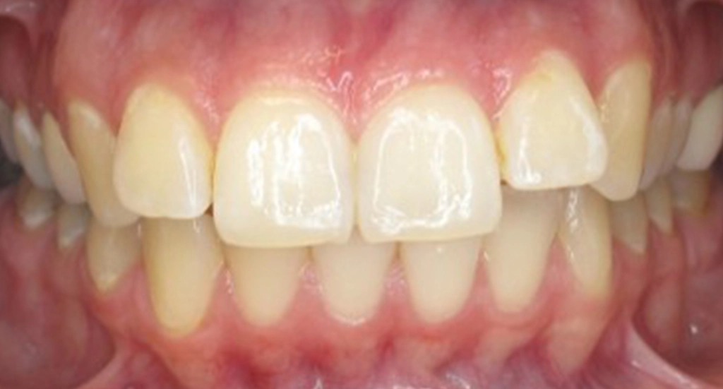Invisalign7TeethBefore Invisalign7TeethBefore