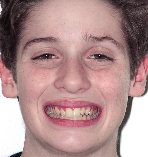 Invisalign8Before Invisalign8Before