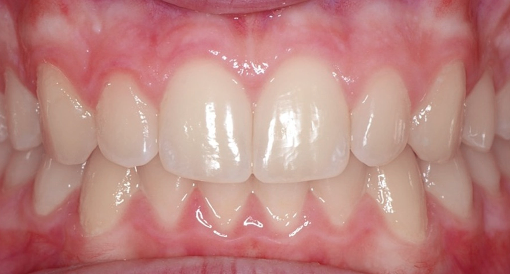 Invisalign8TeethAfter Invisalign8TeethAfter