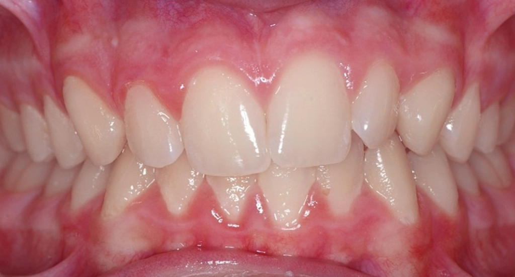 Invisalign8TeethBeforewebp Invisalign8TeethBeforewebp