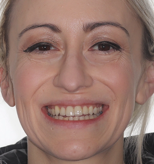 Invisalign9After Invisalign9After