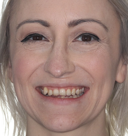 Invisalign9Before Invisalign9Before