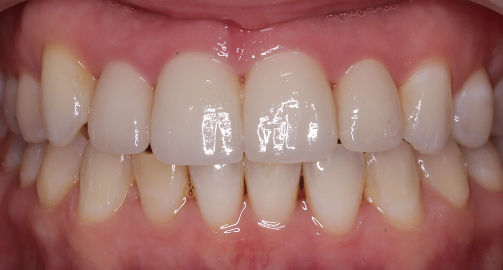 Invisalign9TeethAfter Invisalign9TeethAfter