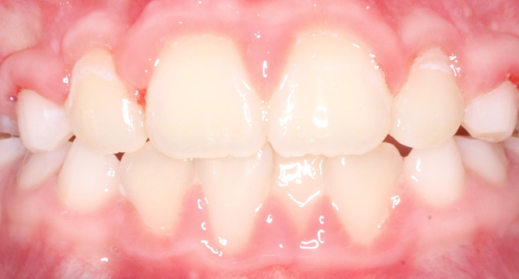 OpenBite2TeethAfter OpenBite2TeethAfter