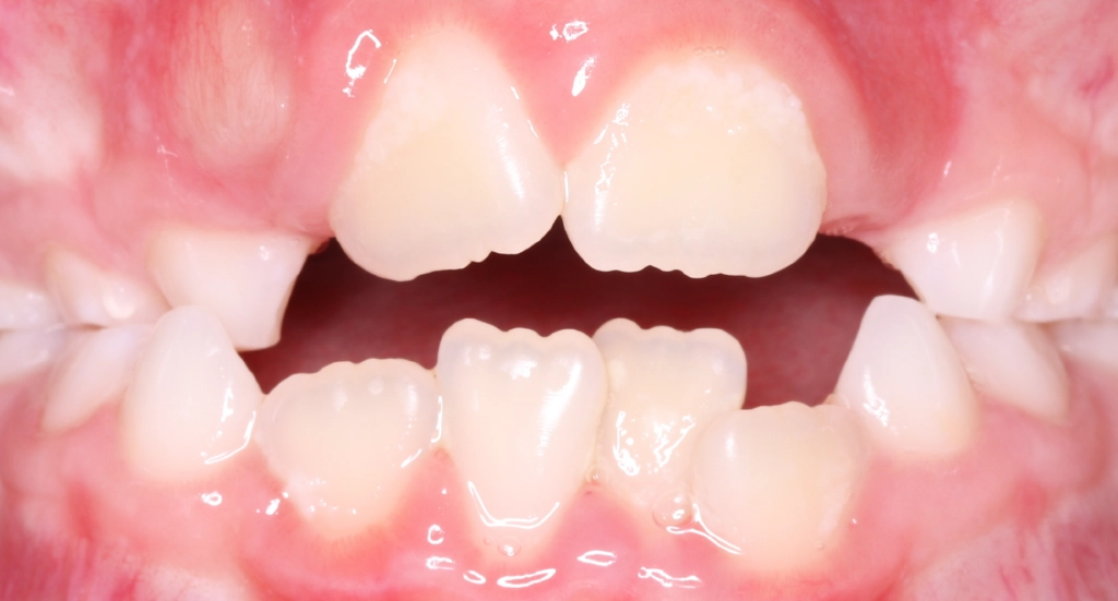 OpenBite2TeethBefore OpenBite2TeethBefore