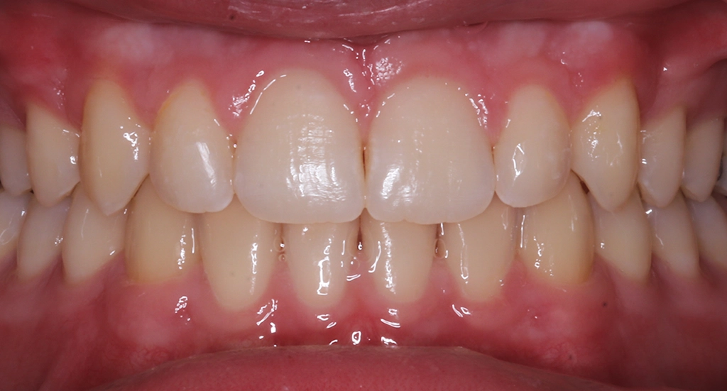 OpenBite3TeethAfter OpenBite3TeethAfter