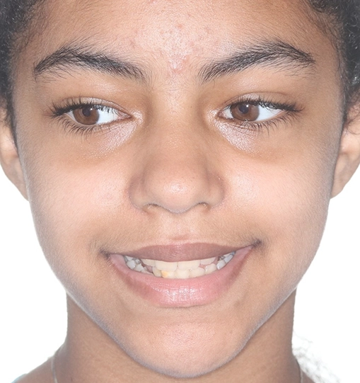 Overbite1Before Overbite1Before