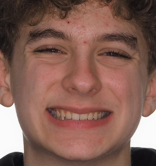 Overbite4After Overbite4After