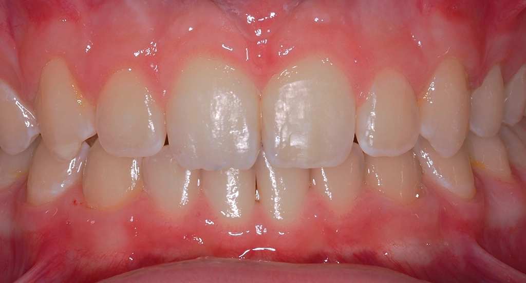 Overbite4TeethAfter1 Overbite4TeethAfter1