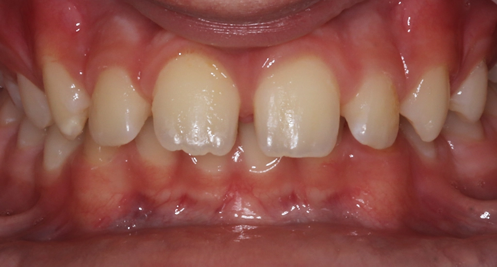 Overbite4TeethBefore Overbite4TeethBefore