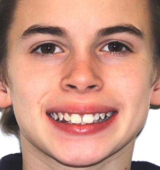 Overbite5Before Overbite5Before