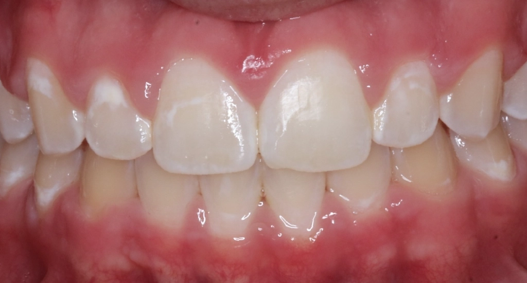 Overbite5TeethAfter Overbite5TeethAfter