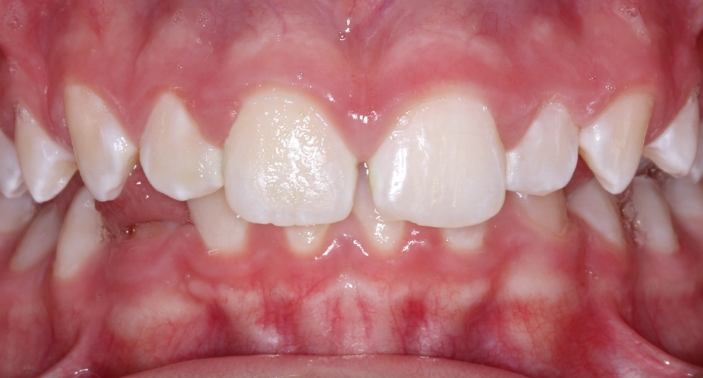 Overbite5TeethBefore Overbite5TeethBefore