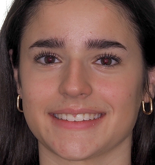 Overbite6After Overbite6After