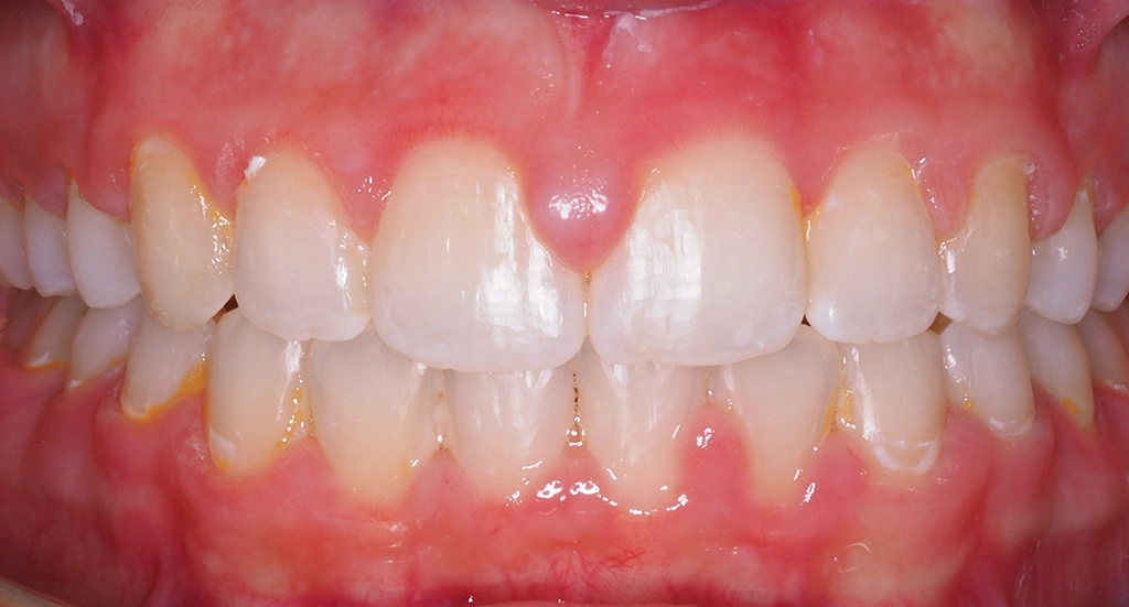 Overbite6TeethAfter Overbite6TeethAfter