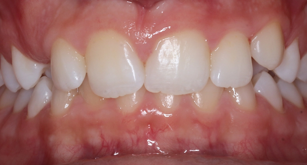Overbite6TeethBefore Overbite6TeethBefore