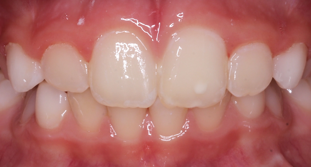 Phase1TeethAfter Phase1TeethAfter