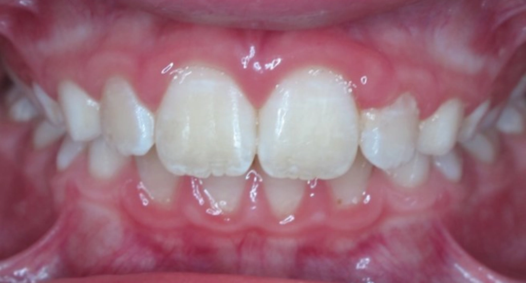 Phase1TeethAfter10 Phase1TeethAfter10