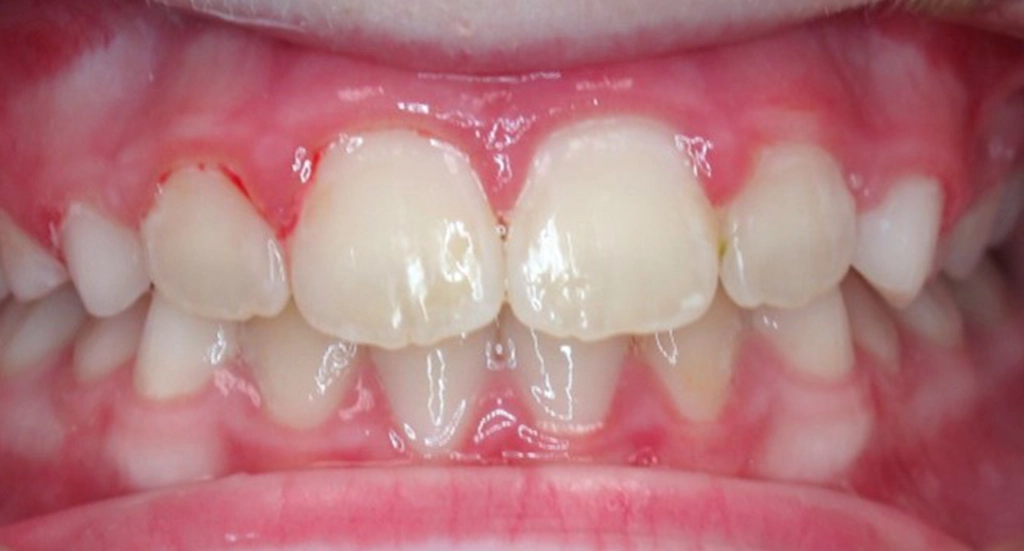 Phase1TeethAfter11 Phase1TeethAfter11