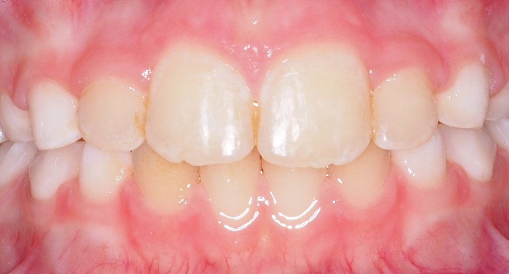 Phase1TeethAfter12 Phase1TeethAfter12
