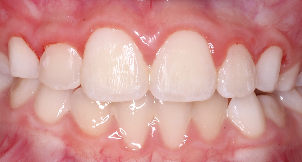 Phase1TeethAfter2 Phase1TeethAfter2
