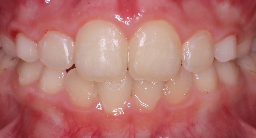 Phase1TeethAfter3 Phase1TeethAfter3
