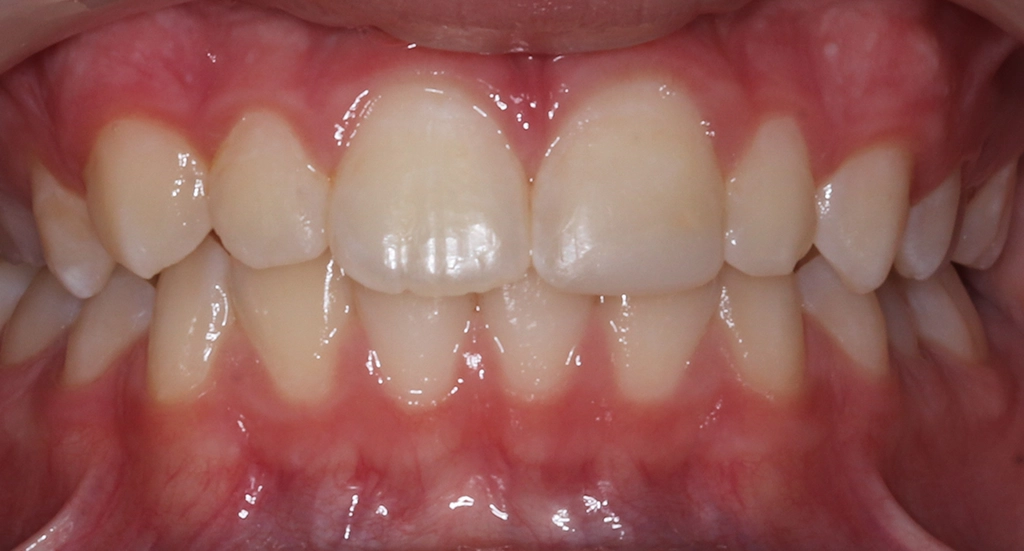 Phase1TeethAfter5 Phase1TeethAfter5