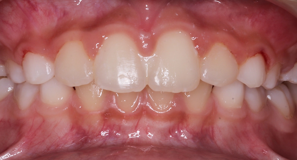 Phase1TeethAfter6 Phase1TeethAfter6