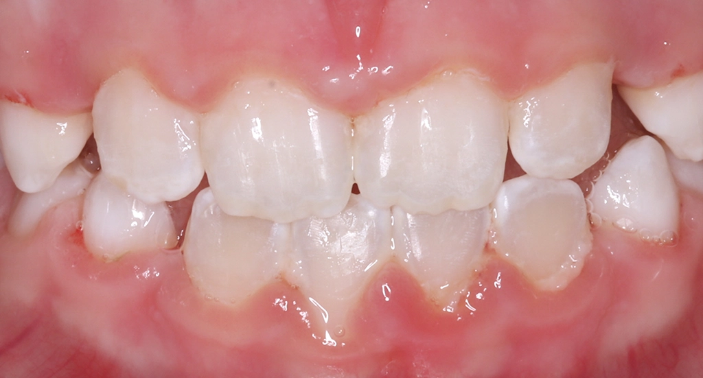 Phase1TeethAfter7 Phase1TeethAfter7