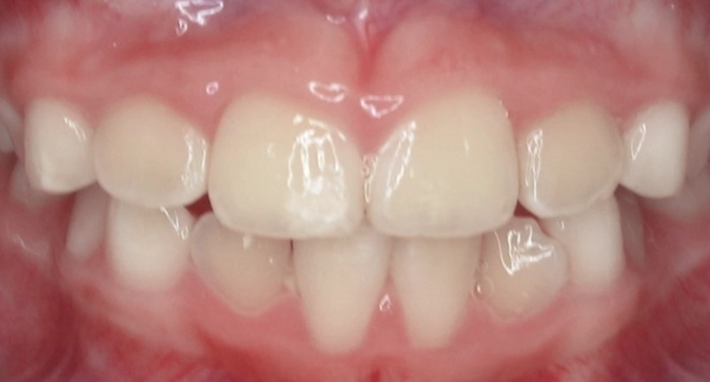 Phase1TeethAfter8 Phase1TeethAfter8