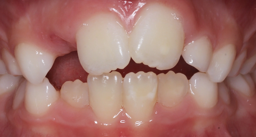 Phase1TeethBefore Phase1TeethBefore