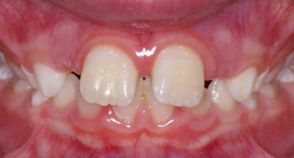Phase1TeethBefore10 Phase1TeethBefore10
