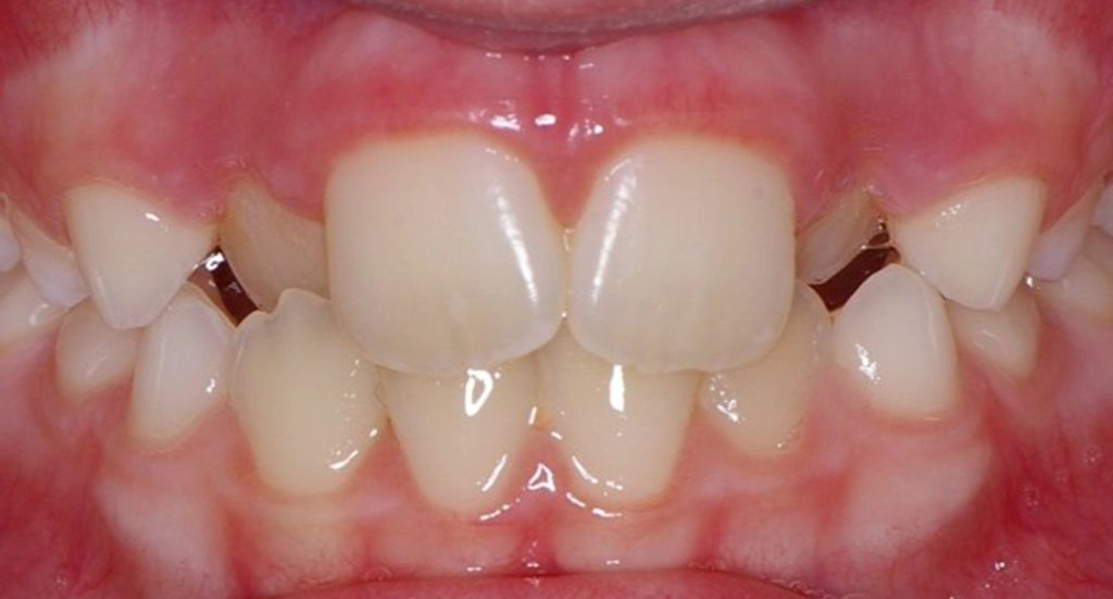 Phase1TeethBefore11 Phase1TeethBefore11