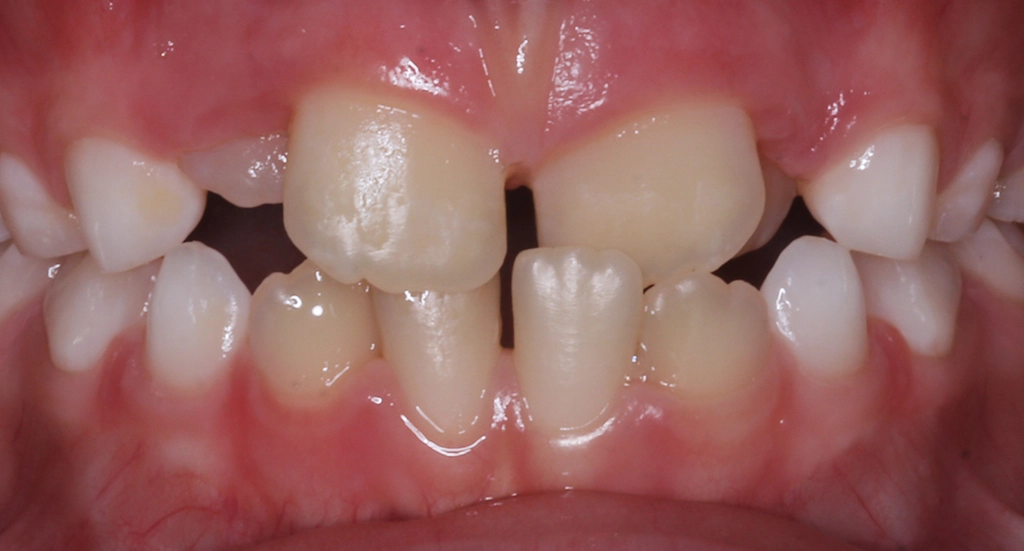 Phase1TeethBefore12 Phase1TeethBefore12