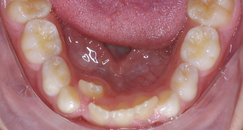 Phase1TeethBefore4 Phase1TeethBefore4