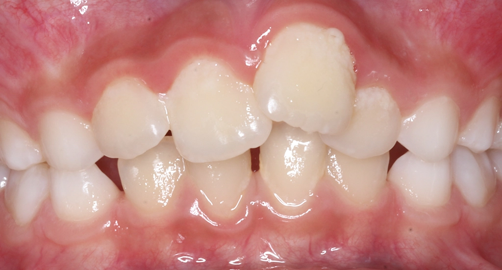 Phase1TeethBefore6 Phase1TeethBefore6