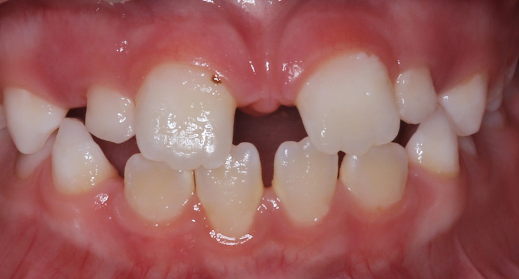 Phase1TeethBefore7 Phase1TeethBefore7