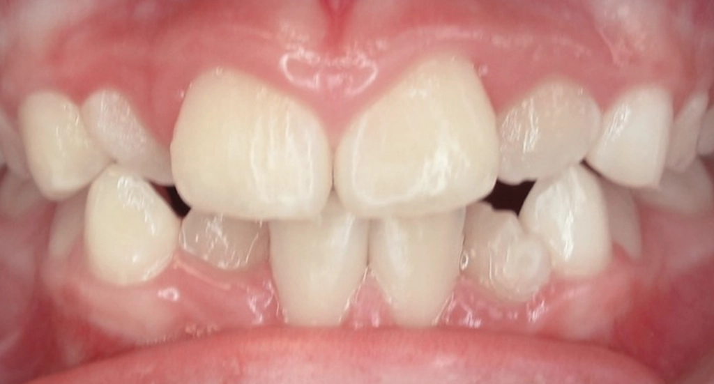 Phase1TeethBefore8 Phase1TeethBefore8