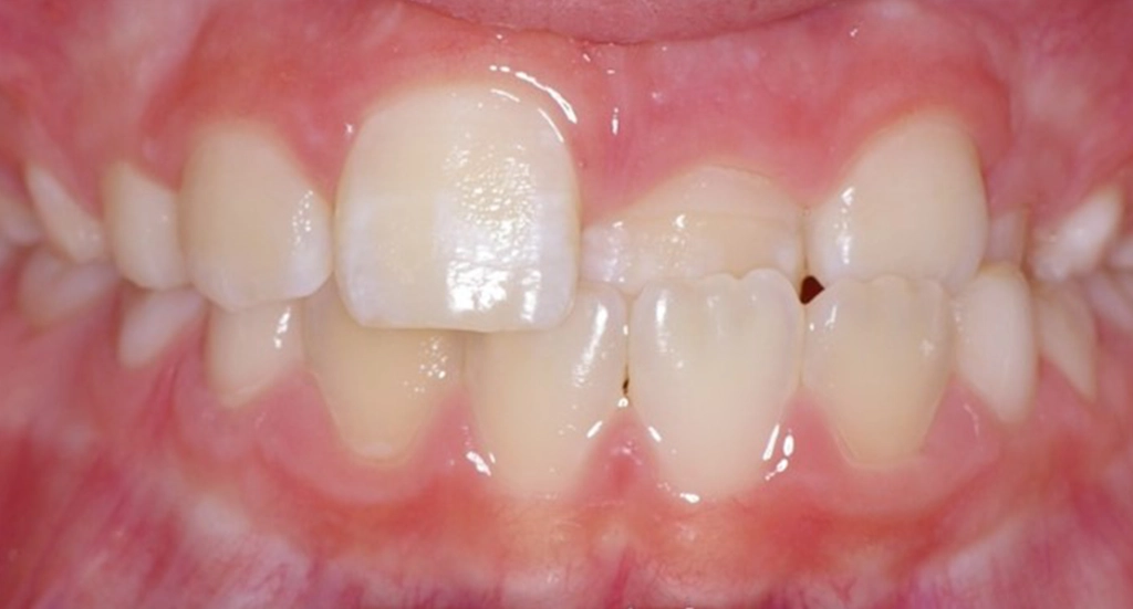 Phase1TeethBefore9 Phase1TeethBefore9