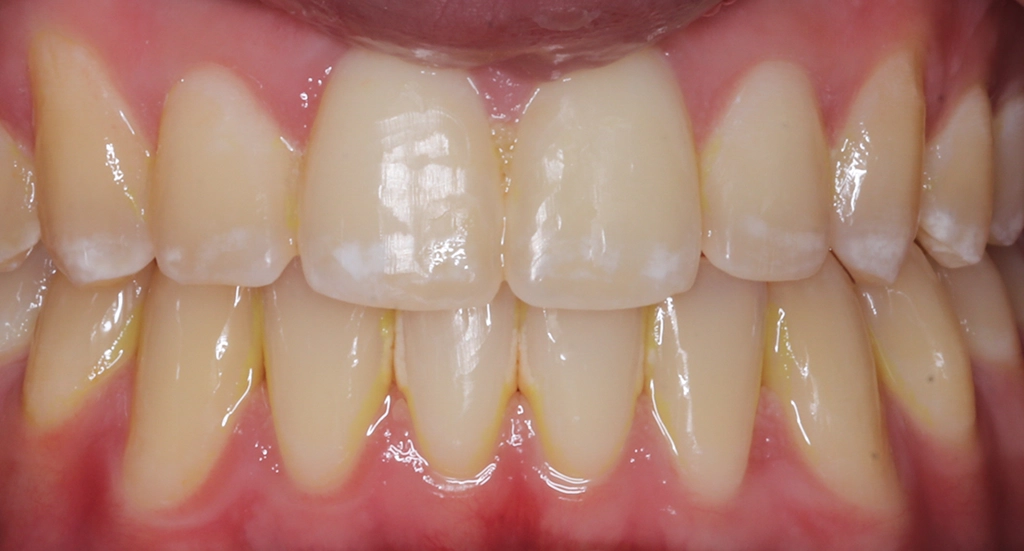 Spacing1TeethAfter Spacing1TeethAfter