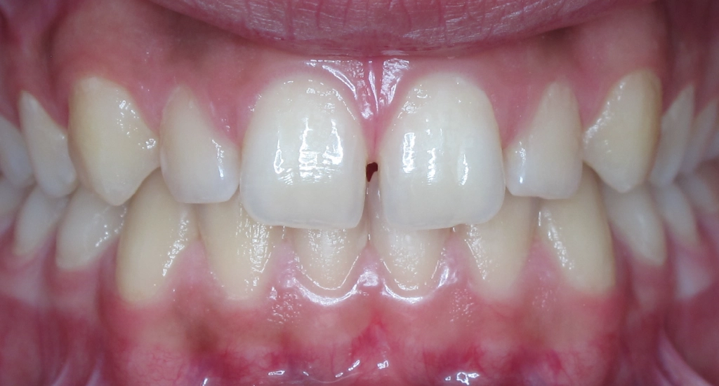 Spacing2TeethBefore Spacing2TeethBefore