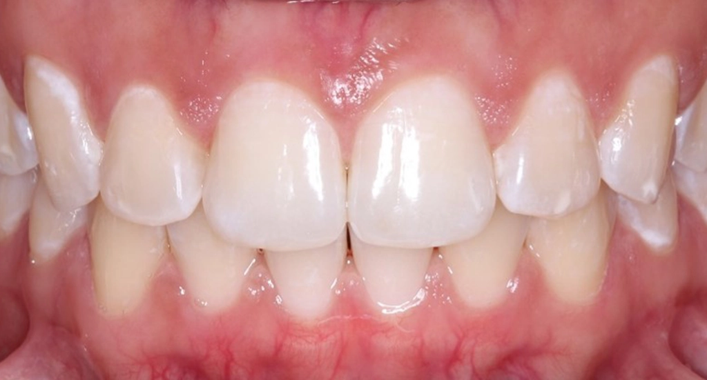 Spacing3TeethAfter Spacing3TeethAfter